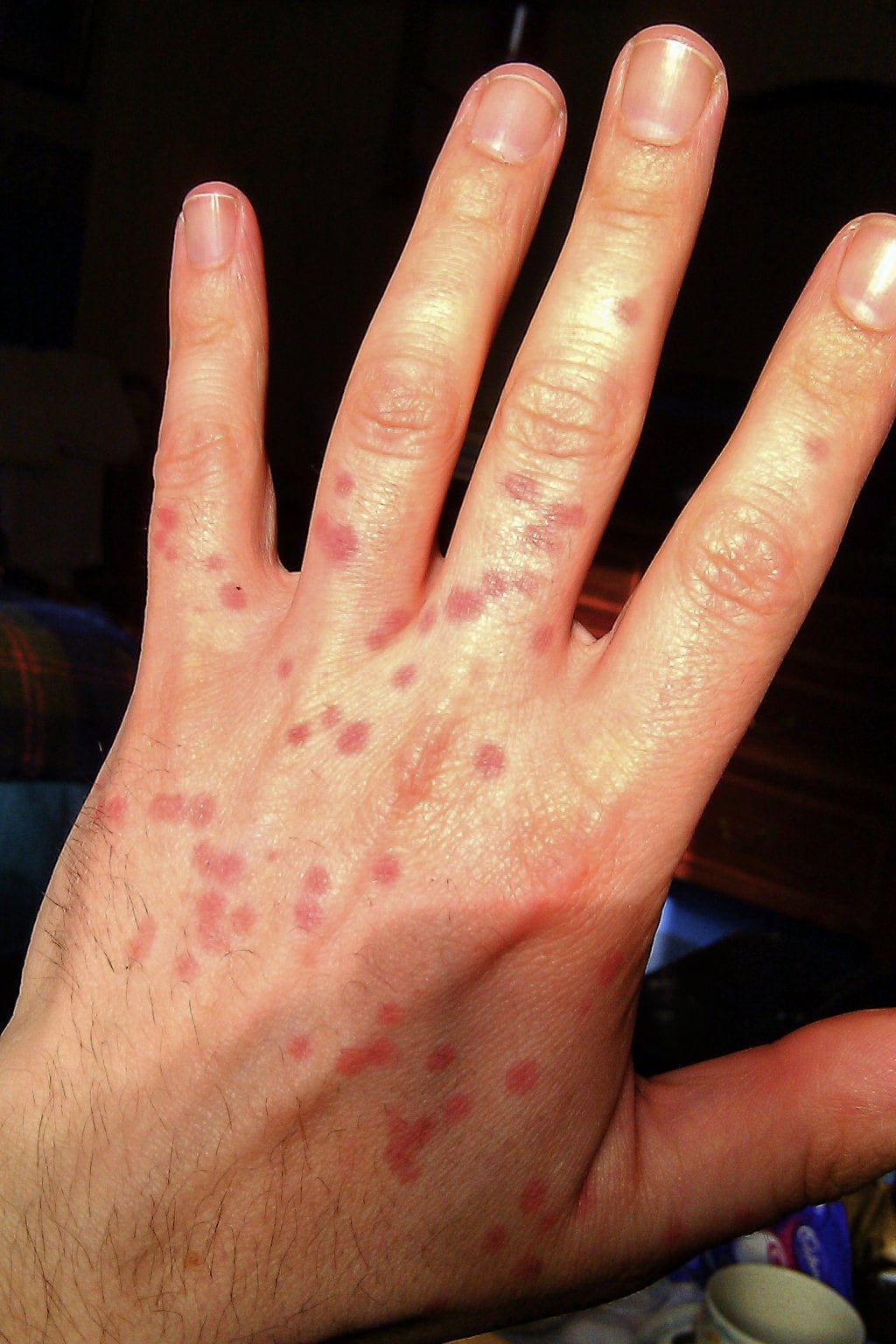 Midge Bites